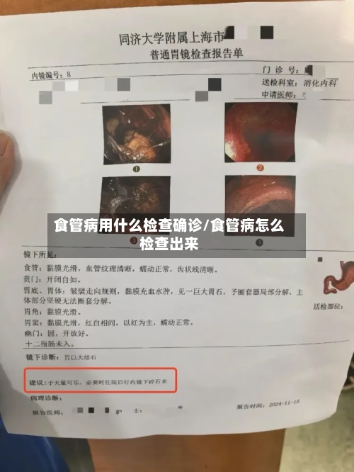 食管病用什么检查确诊/食管病怎么检查出来-第2张图片