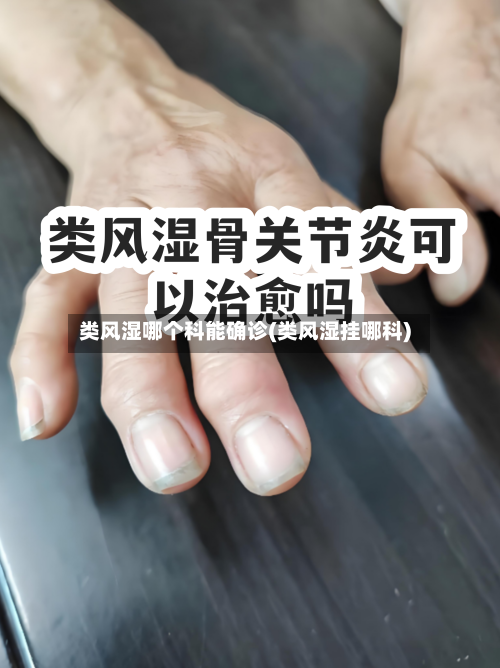 类风湿哪个科能确诊(类风湿挂哪科)