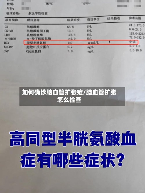 如何确诊脑血管扩张症/脑血管扩张怎么检查-第2张图片