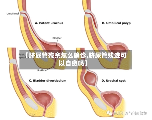 【脐尿管残余怎么确诊,脐尿管残迹可以自愈吗】