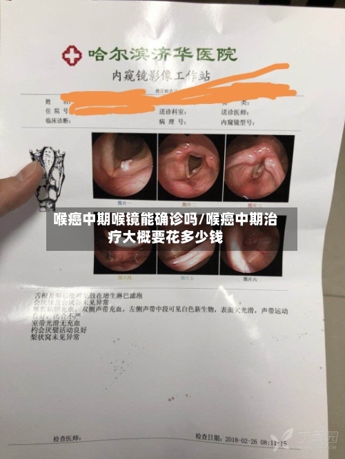 喉癌中期喉镜能确诊吗/喉癌中期治疗大概要花多少钱-第2张图片