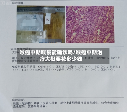 喉癌中期喉镜能确诊吗/喉癌中期治疗大概要花多少钱