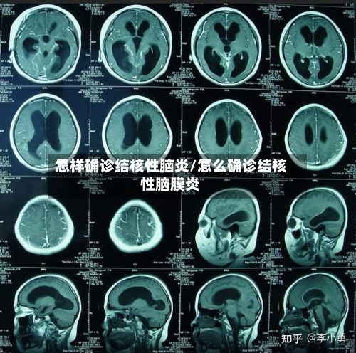 怎样确诊结核性脑炎/怎么确诊结核性脑膜炎