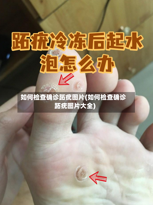 如何检查确诊跖疣图片(如何检查确诊跖疣图片大全)