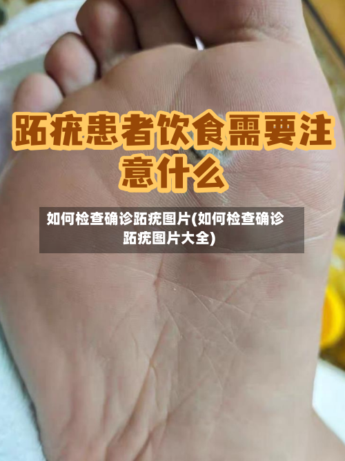 如何检查确诊跖疣图片(如何检查确诊跖疣图片大全)-第3张图片