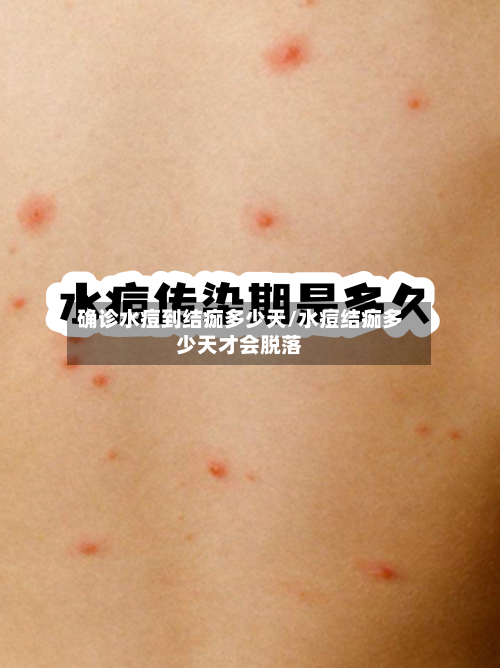确诊水痘到结痂多少天/水痘结痂多少天才会脱落