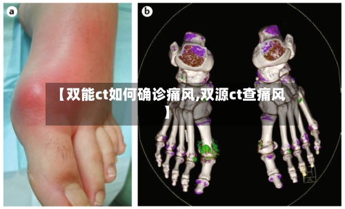 【双能ct如何确诊痛风,双源ct查痛风】-第2张图片