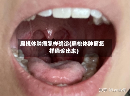 扁桃体肿瘤怎样确诊(扁桃体肿瘤怎样确诊出来)